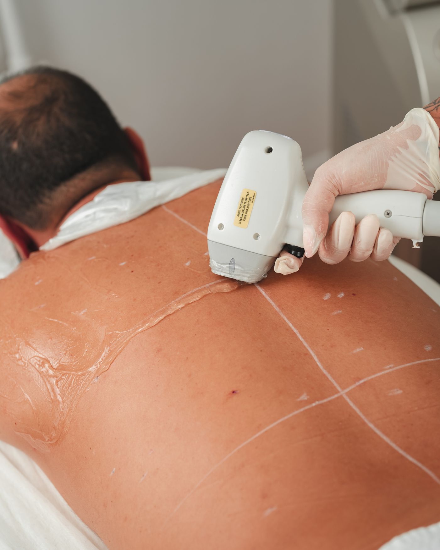 A specialist performing a laser treatment on a client's back in a clinic